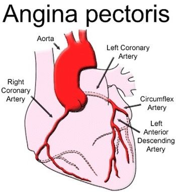 11. Angina