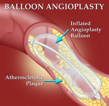 12. Surgery – Angioplasty