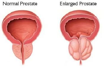 (12) Prostate Disorders