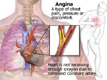(9) Heart Attack and Cardiac Disorders