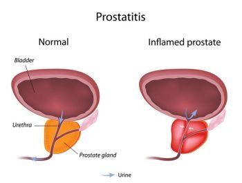 (11) Prostate Disorder