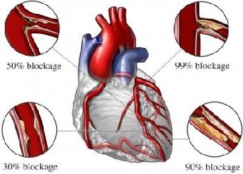 (13) Heart Attack and Cardiac Disorders