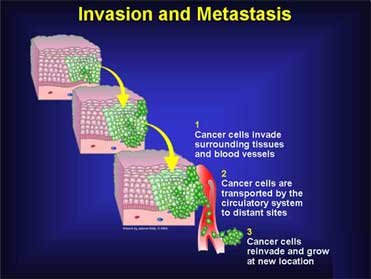 cancer-metastasis