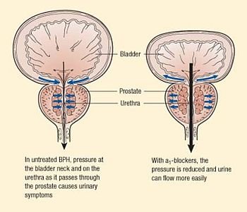 (19) Prostate Disorder