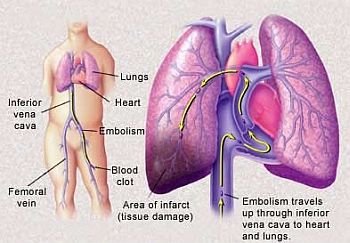 (31) Heart Attack and Cardiac Disorders