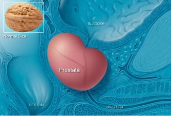 (21) Prostate Disorder