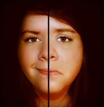 (47) Bipolar Disorder