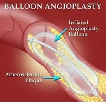 (39) Heart Attack and Cardiac Disorders