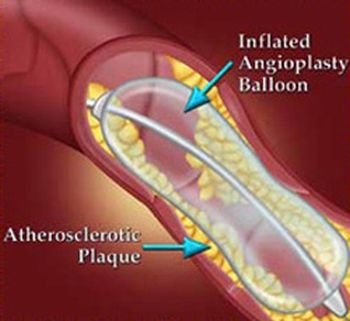 (40) Heart Attack and Cardiac Disorders