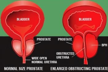 (23) Prostate Disorder